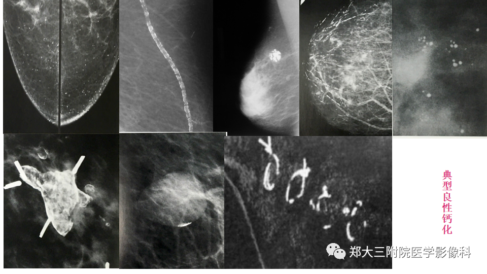 影像PPT - 【PPT】乳腺X线BI-RADS分类解读及常见病X线诊断-29
