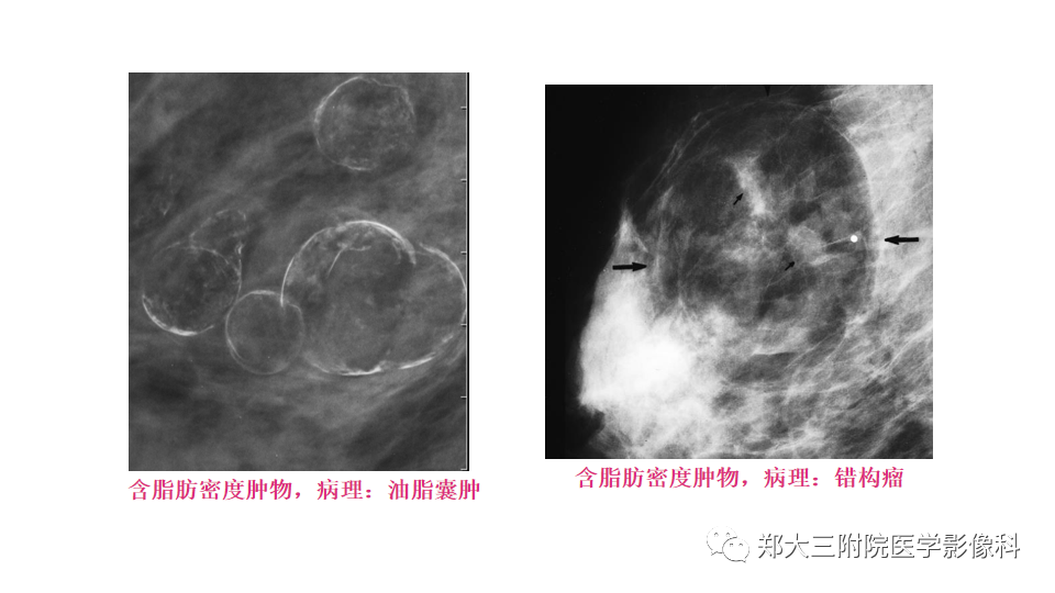 影像PPT - 【PPT】乳腺X线BI-RADS分类解读及常见病X线诊断-30