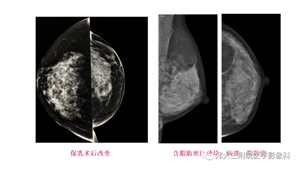 影像PPT - 【PPT】乳腺X线BI-RADS分类解读及常见病X线诊断-31