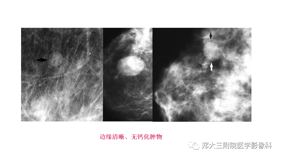 影像PPT - 【PPT】乳腺X线BI-RADS分类解读及常见病X线诊断-36