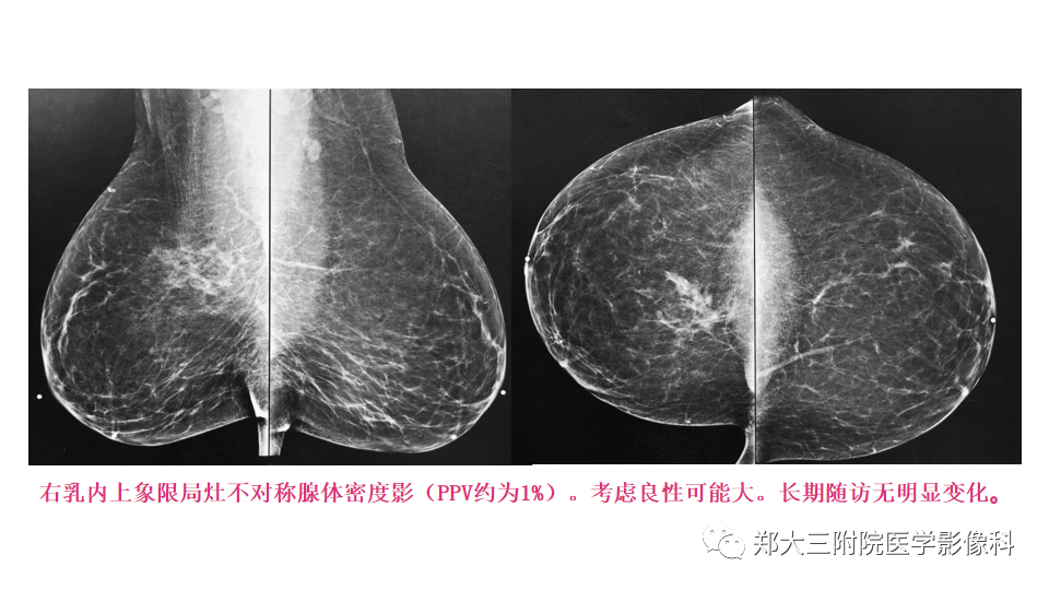影像PPT - 【PPT】乳腺X线BI-RADS分类解读及常见病X线诊断-37