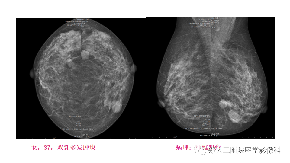 影像PPT - 【PPT】乳腺X线BI-RADS分类解读及常见病X线诊断-40