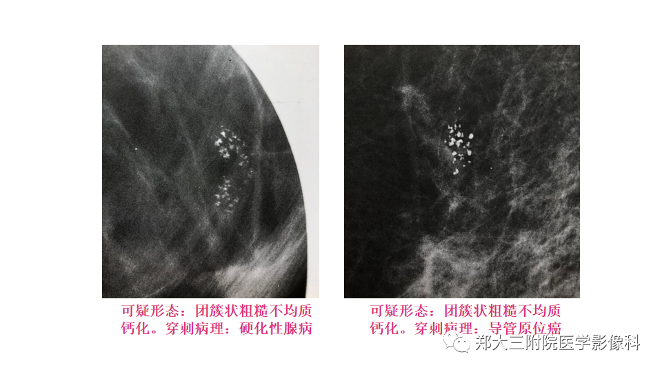 影像PPT - 【PPT】乳腺X线BI-RADS分类解读及常见病X线诊断-42