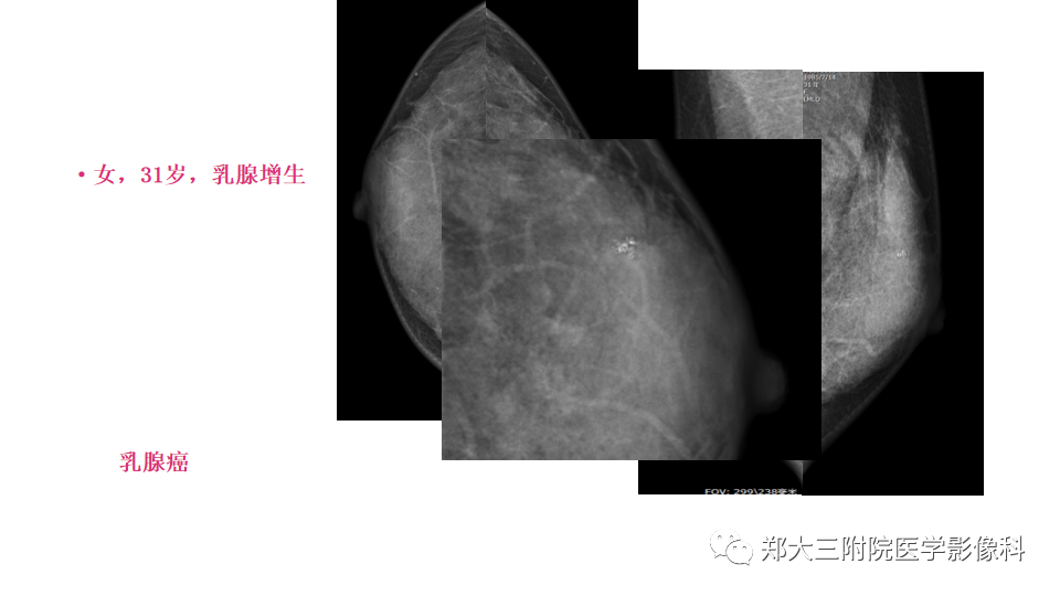 影像PPT - 【PPT】乳腺X线BI-RADS分类解读及常见病X线诊断-43