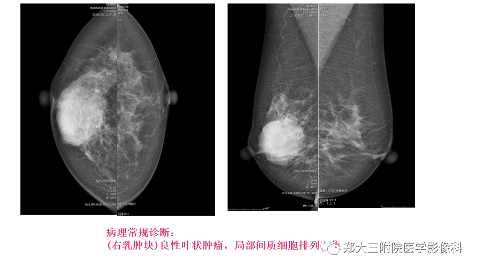 影像PPT - 【PPT】乳腺X线BI-RADS分类解读及常见病X线诊断-44