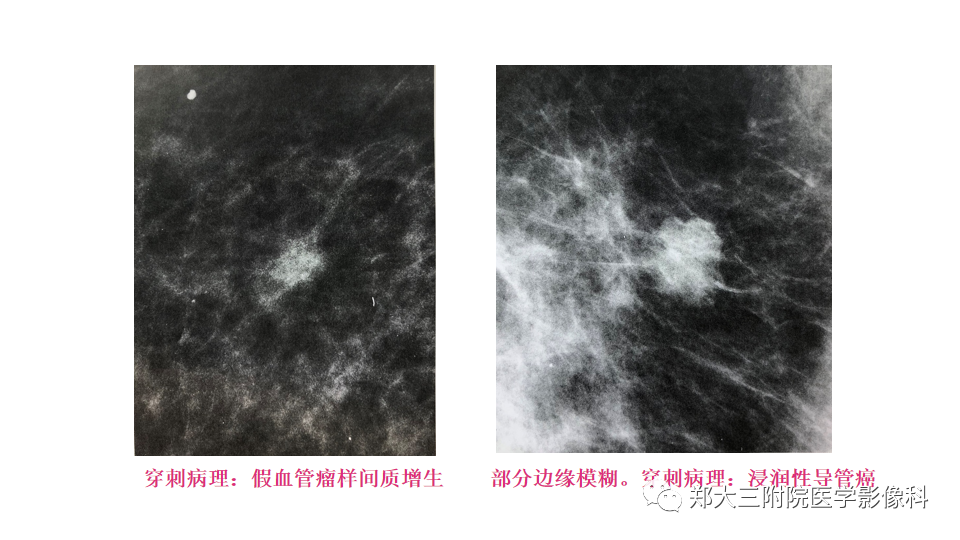影像PPT - 【PPT】乳腺X线BI-RADS分类解读及常见病X线诊断-46