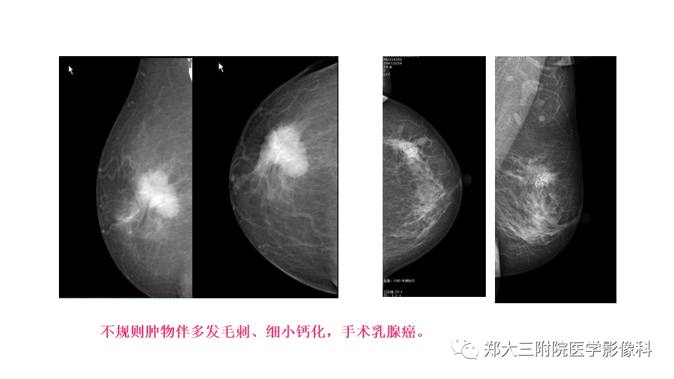 影像PPT - 【PPT】乳腺X线BI-RADS分类解读及常见病X线诊断-48