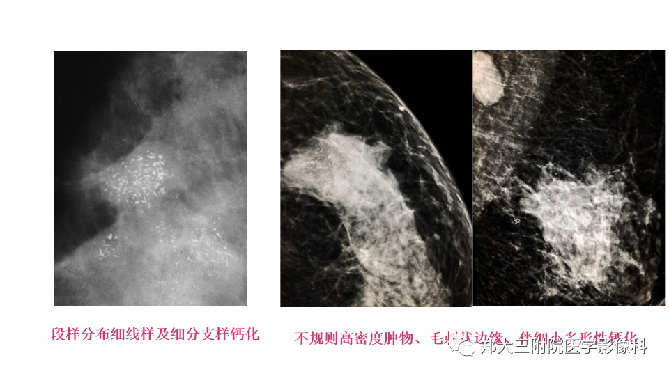 影像PPT - 【PPT】乳腺X线BI-RADS分类解读及常见病X线诊断-49