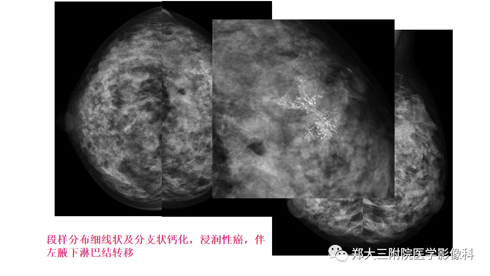 影像PPT - 【PPT】乳腺X线BI-RADS分类解读及常见病X线诊断-50