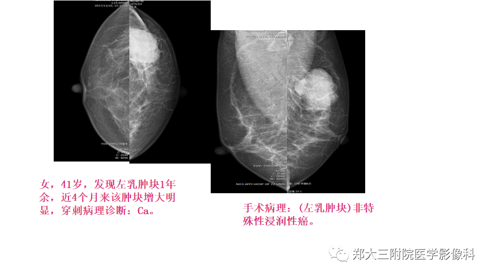 影像PPT - 【PPT】乳腺X线BI-RADS分类解读及常见病X线诊断-52