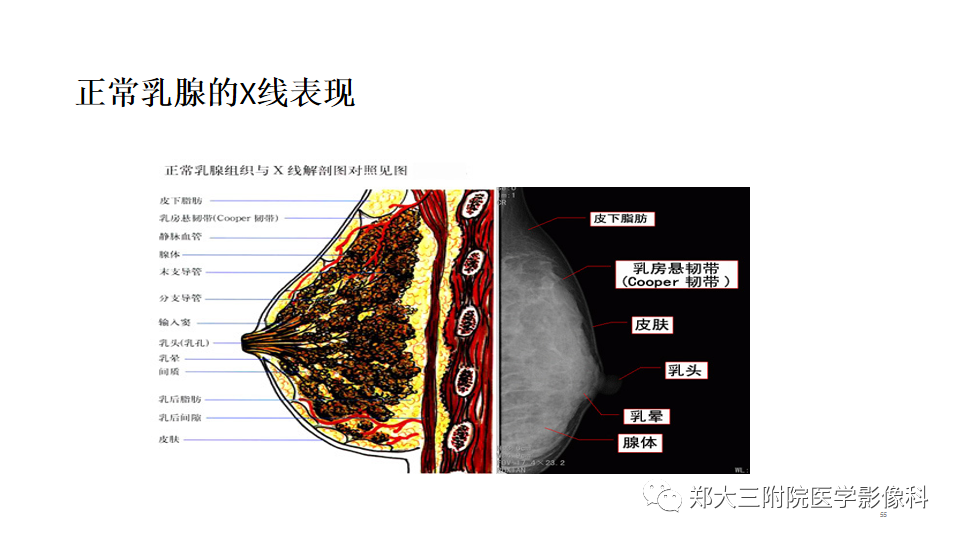 影像PPT - 【PPT】乳腺X线BI-RADS分类解读及常见病X线诊断-55