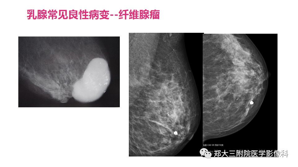 影像PPT - 【PPT】乳腺X线BI-RADS分类解读及常见病X线诊断-64