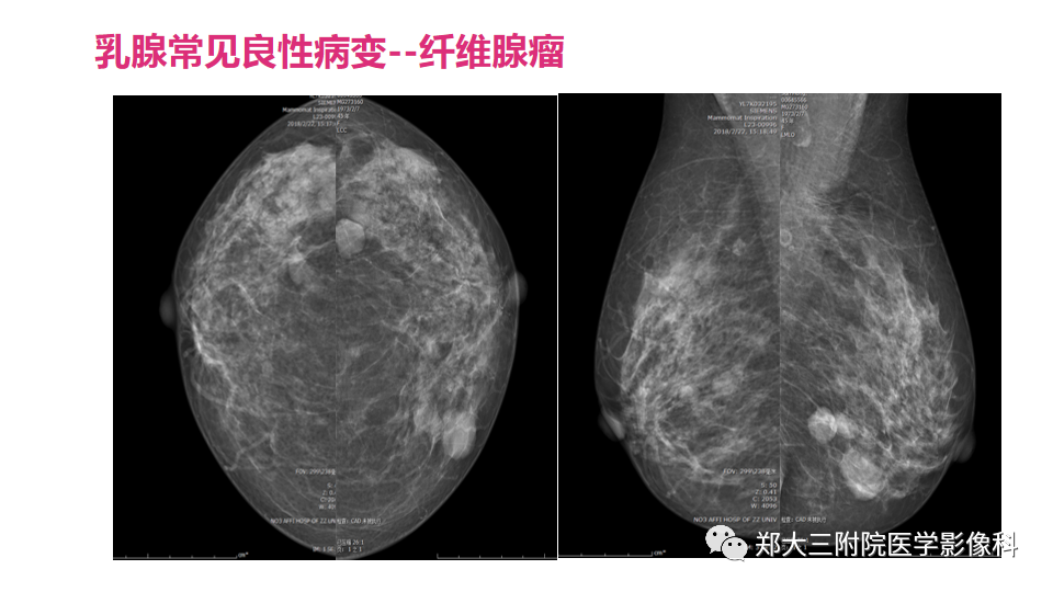 影像PPT - 【PPT】乳腺X线BI-RADS分类解读及常见病X线诊断-65