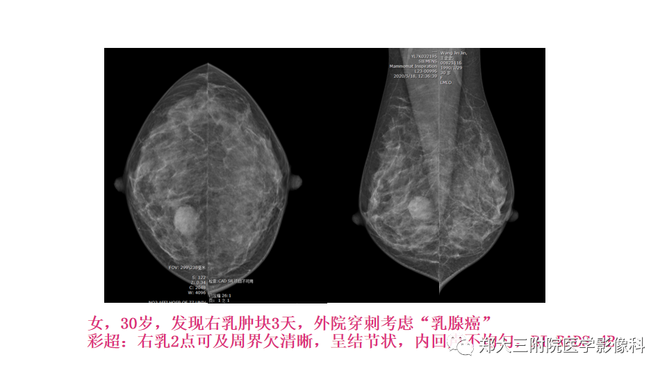 影像PPT - 【PPT】乳腺X线BI-RADS分类解读及常见病X线诊断-66