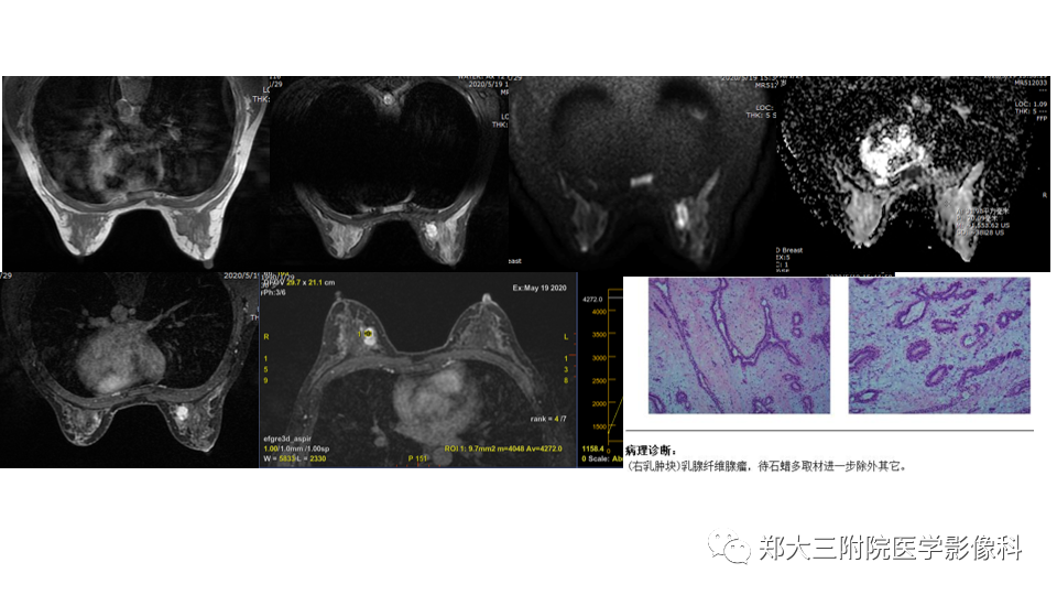 影像PPT - 【PPT】乳腺X线BI-RADS分类解读及常见病X线诊断-67