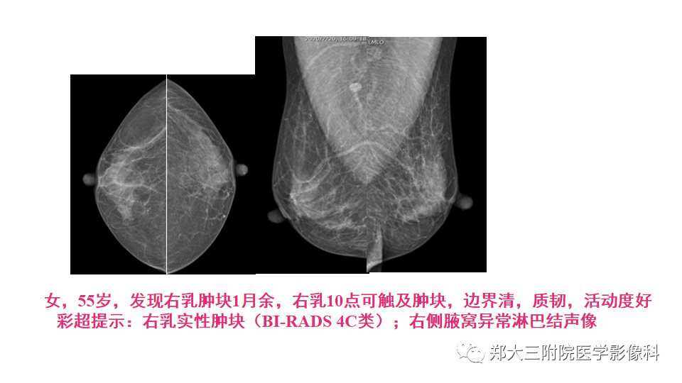 影像PPT - 【PPT】乳腺X线BI-RADS分类解读及常见病X线诊断-70