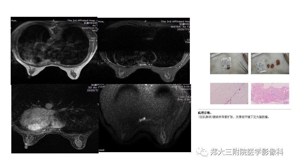 影像PPT - 【PPT】乳腺X线BI-RADS分类解读及常见病X线诊断-71