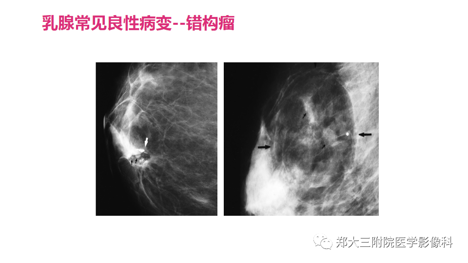 影像PPT - 【PPT】乳腺X线BI-RADS分类解读及常见病X线诊断-75