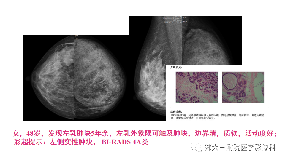 影像PPT - 【PPT】乳腺X线BI-RADS分类解读及常见病X线诊断-76