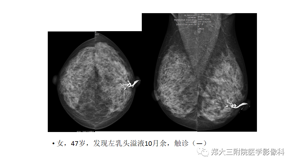 影像PPT - 【PPT】乳腺X线BI-RADS分类解读及常见病X线诊断-79