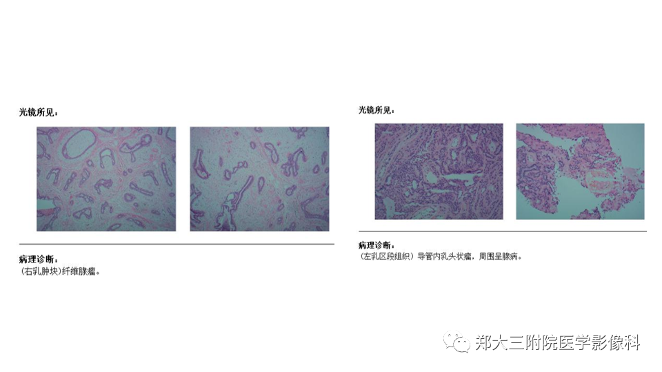影像PPT - 【PPT】乳腺X线BI-RADS分类解读及常见病X线诊断-80