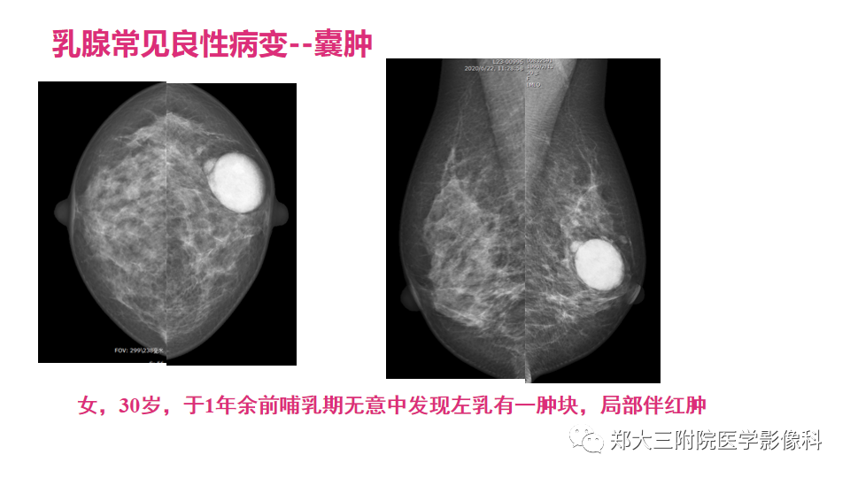 影像PPT - 【PPT】乳腺X线BI-RADS分类解读及常见病X线诊断-83