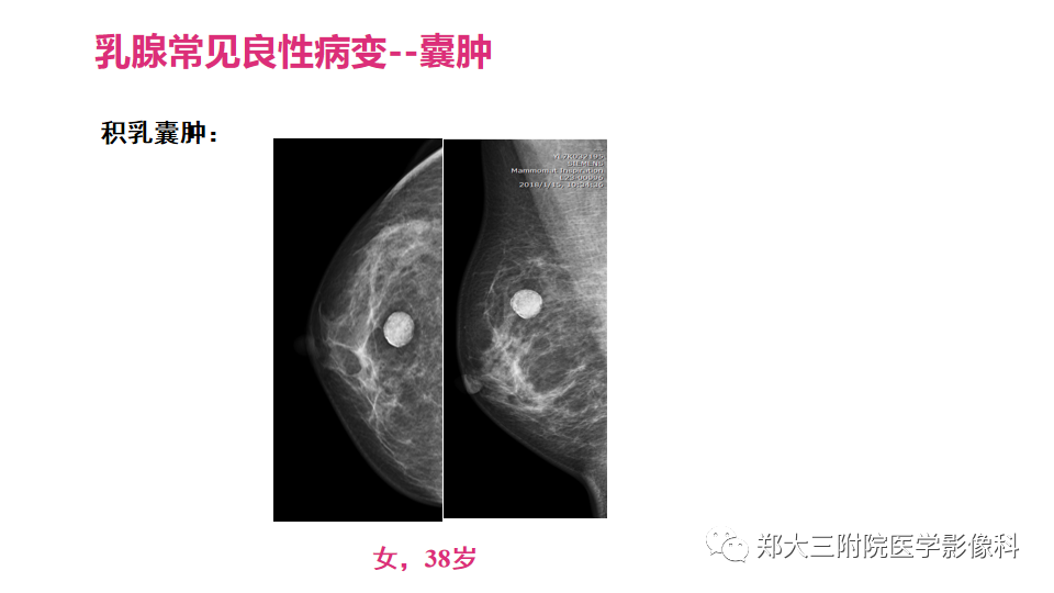 影像PPT - 【PPT】乳腺X线BI-RADS分类解读及常见病X线诊断-85