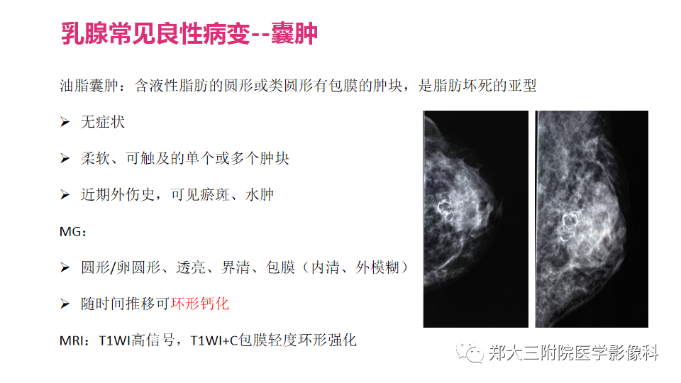 影像PPT - 【PPT】乳腺X线BI-RADS分类解读及常见病X线诊断-86
