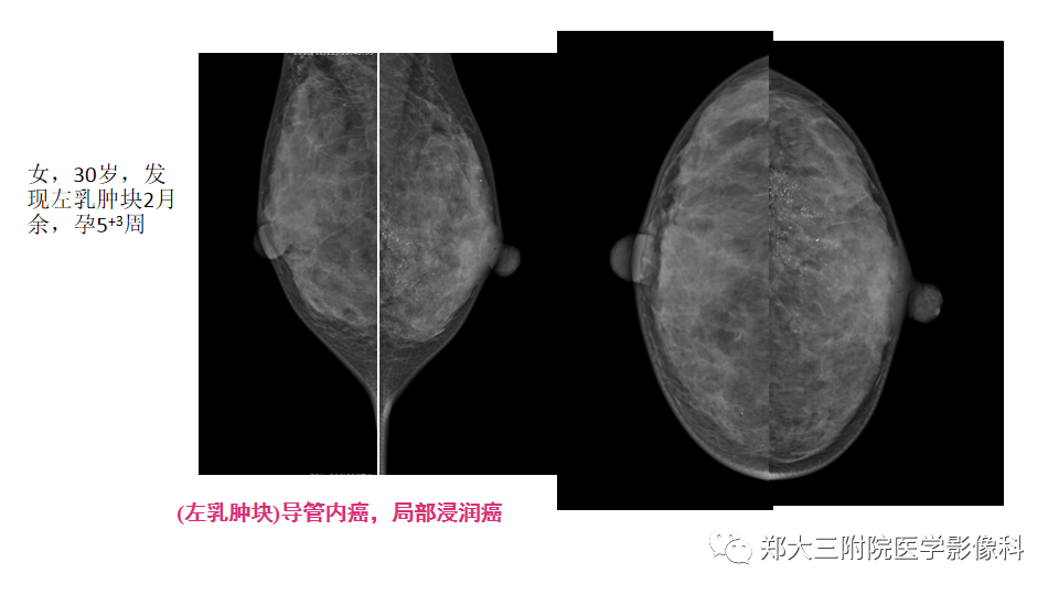影像PPT - 【PPT】乳腺X线BI-RADS分类解读及常见病X线诊断-94