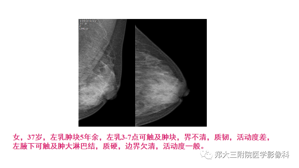 影像PPT - 【PPT】乳腺X线BI-RADS分类解读及常见病X线诊断-95