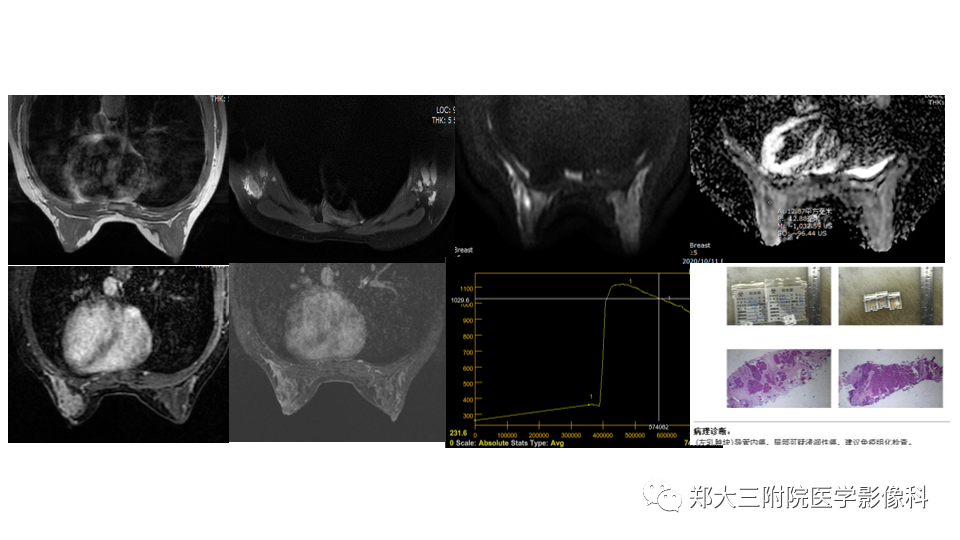 影像PPT - 【PPT】乳腺X线BI-RADS分类解读及常见病X线诊断-96