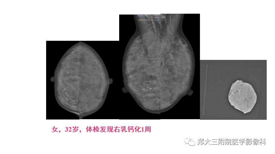影像PPT - 【PPT】乳腺X线BI-RADS分类解读及常见病X线诊断-97