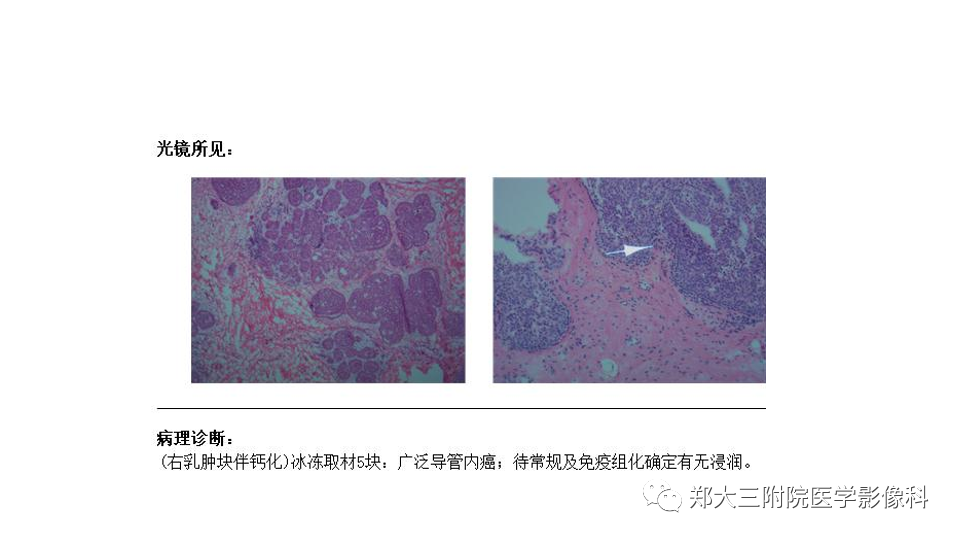 影像PPT - 【PPT】乳腺X线BI-RADS分类解读及常见病X线诊断-99