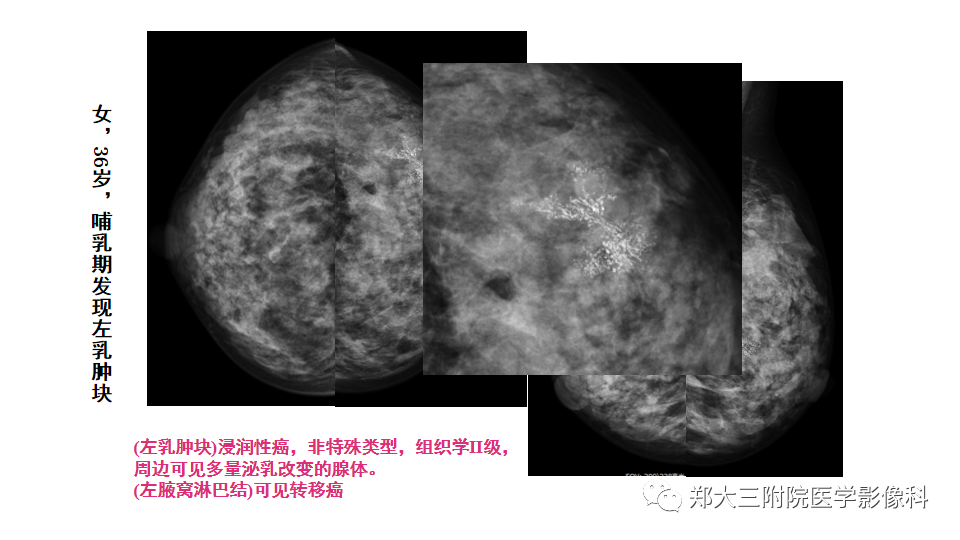 影像PPT - 【PPT】乳腺X线BI-RADS分类解读及常见病X线诊断-101