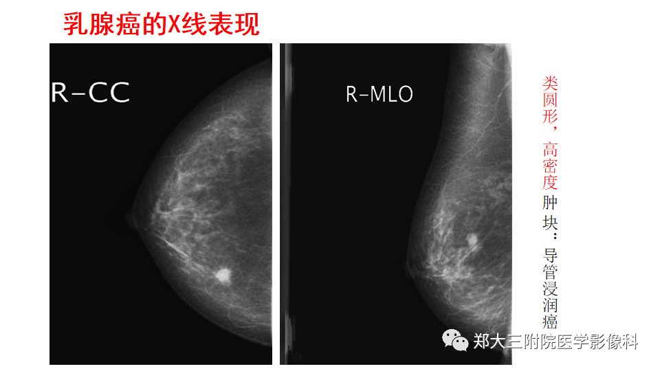 影像PPT - 【PPT】乳腺X线BI-RADS分类解读及常见病X线诊断-102