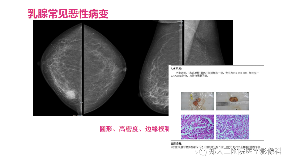 影像PPT - 【PPT】乳腺X线BI-RADS分类解读及常见病X线诊断-103