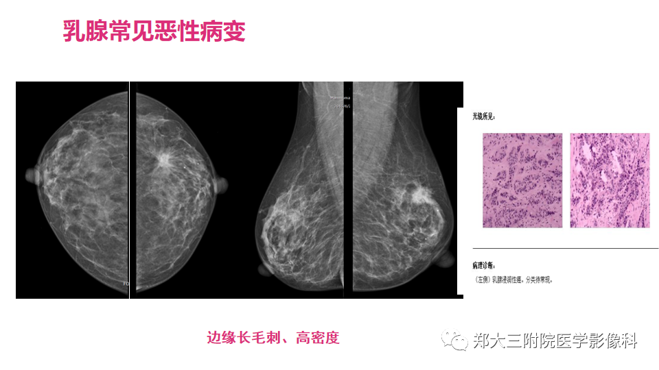影像PPT - 【PPT】乳腺X线BI-RADS分类解读及常见病X线诊断-105
