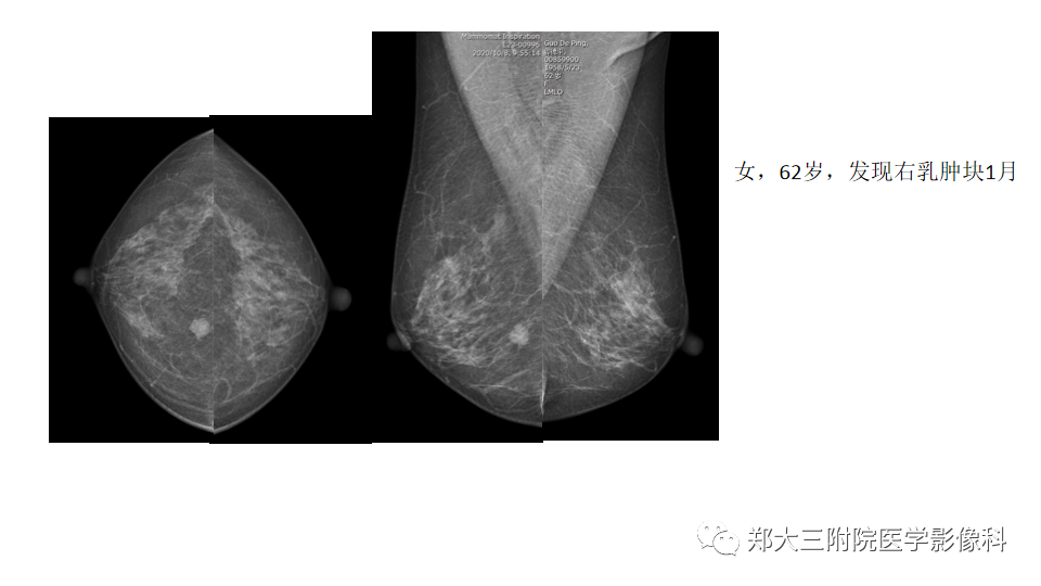 影像PPT - 【PPT】乳腺X线BI-RADS分类解读及常见病X线诊断-106