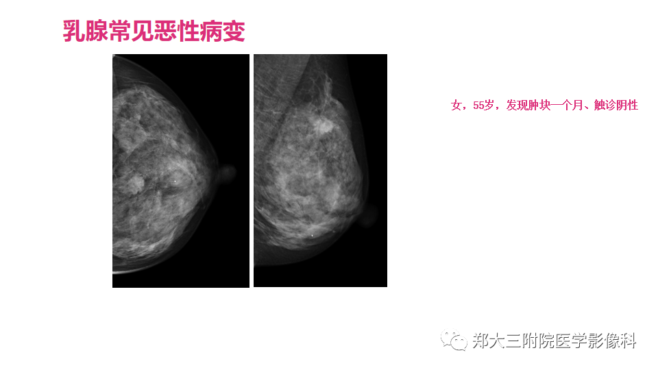 影像PPT - 【PPT】乳腺X线BI-RADS分类解读及常见病X线诊断-109