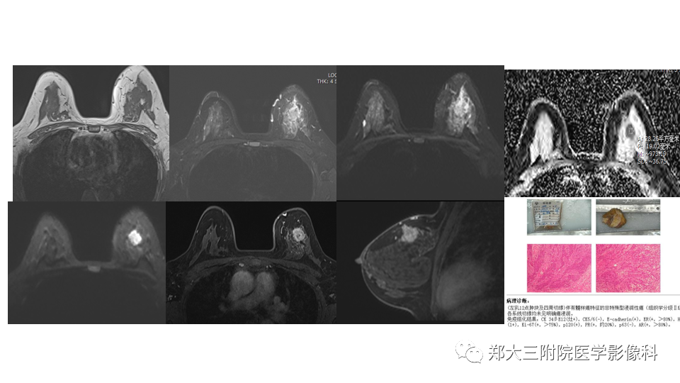 影像PPT - 【PPT】乳腺X线BI-RADS分类解读及常见病X线诊断-110