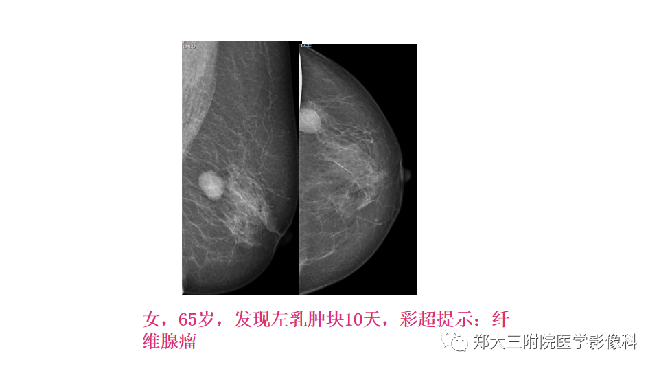 影像PPT - 【PPT】乳腺X线BI-RADS分类解读及常见病X线诊断-112