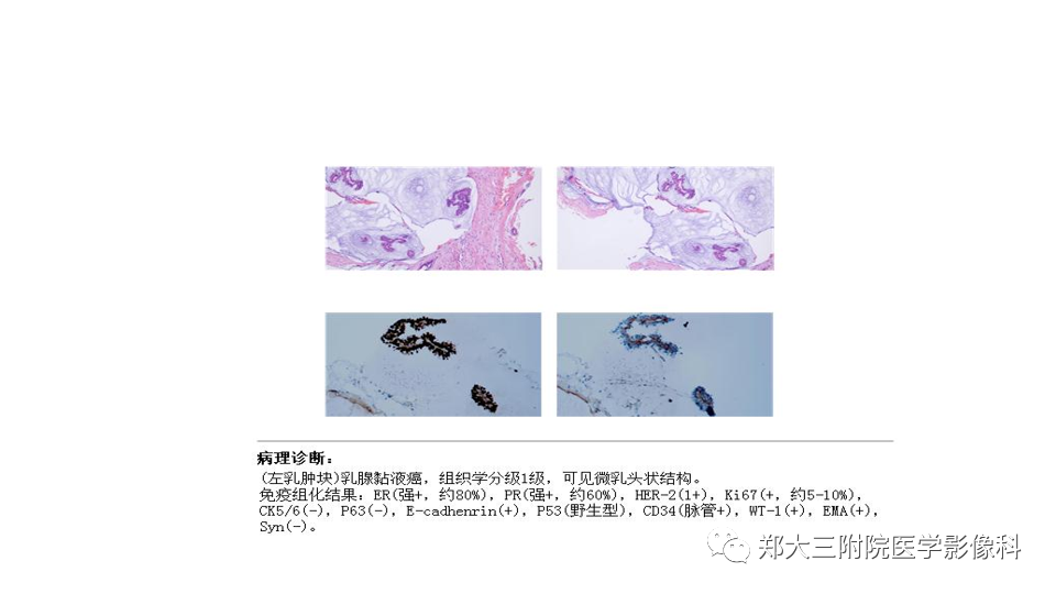 影像PPT - 【PPT】乳腺X线BI-RADS分类解读及常见病X线诊断-114