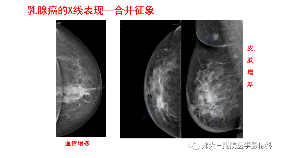 影像PPT - 【PPT】乳腺X线BI-RADS分类解读及常见病X线诊断-115