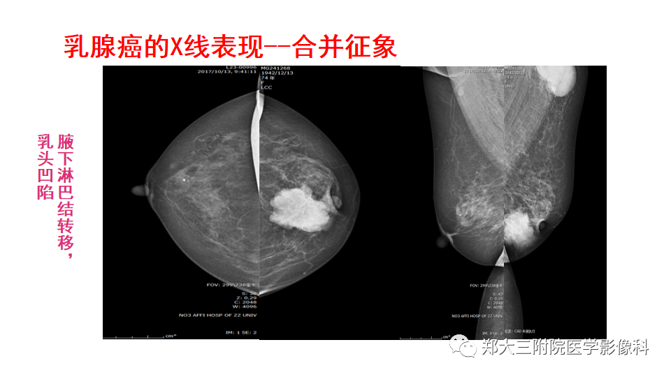 影像PPT - 【PPT】乳腺X线BI-RADS分类解读及常见病X线诊断-116