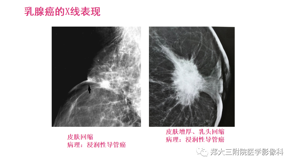 影像PPT - 【PPT】乳腺X线BI-RADS分类解读及常见病X线诊断-117
