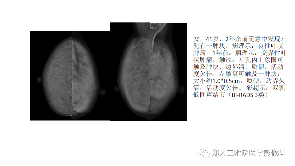 影像PPT - 【PPT】乳腺X线BI-RADS分类解读及常见病X线诊断-120