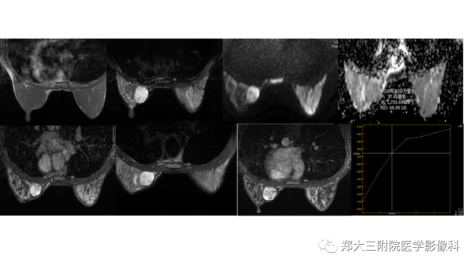 影像PPT - 【PPT】乳腺X线BI-RADS分类解读及常见病X线诊断-121