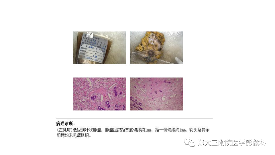 影像PPT - 【PPT】乳腺X线BI-RADS分类解读及常见病X线诊断-122