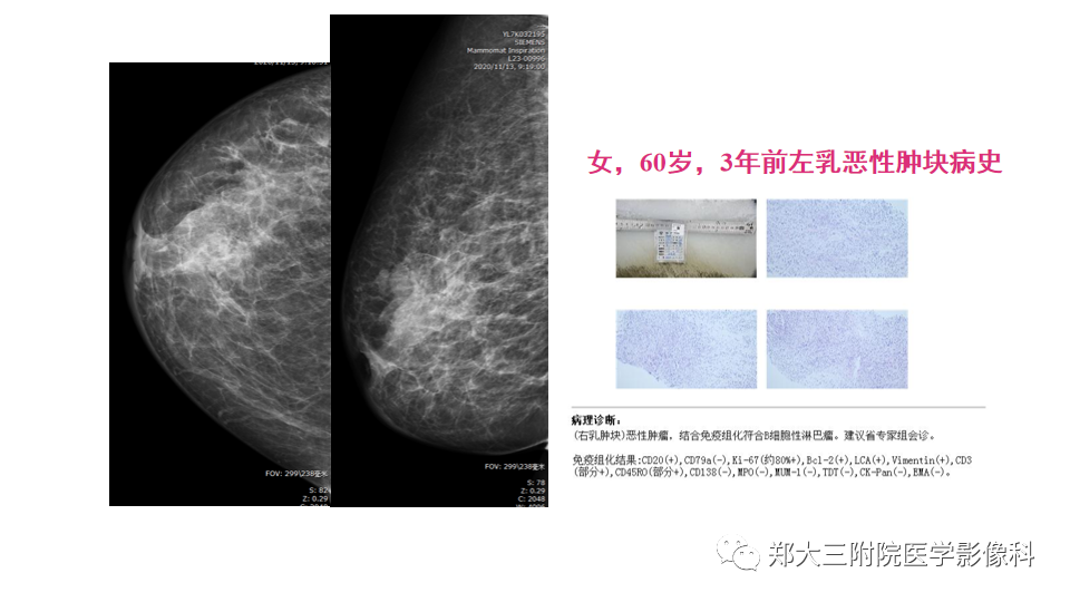 影像PPT - 【PPT】乳腺X线BI-RADS分类解读及常见病X线诊断-125