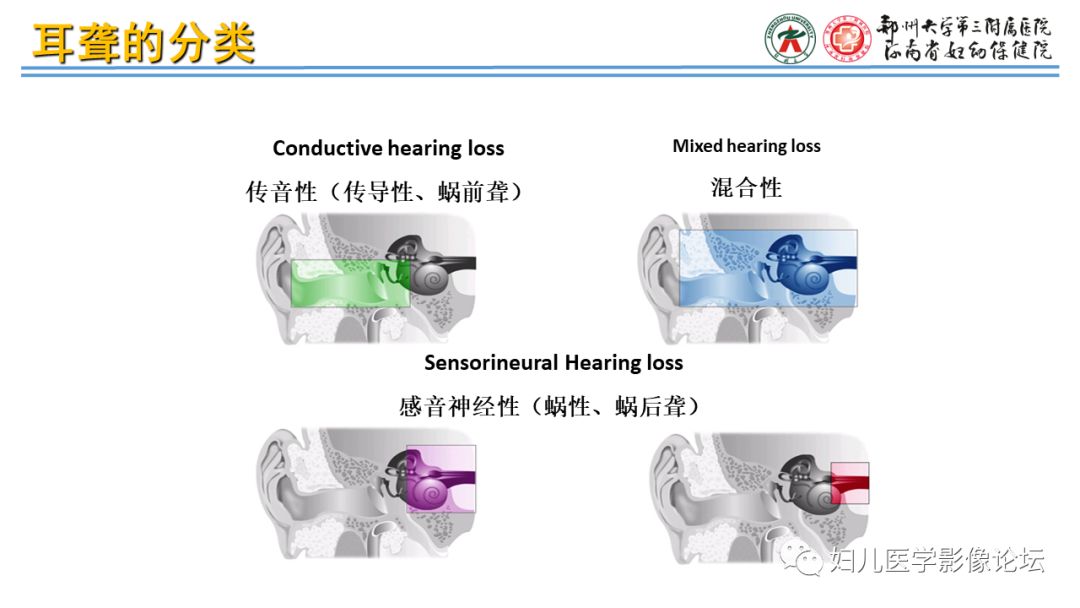 影像PPT - 【PPT】感音神经性耳聋影像诊断-3
